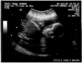 baby scan